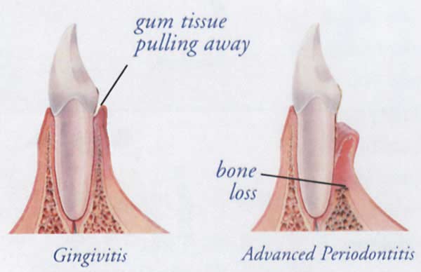 gum disease